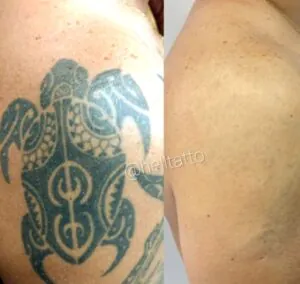 remocao-de-tatuagem-fica-cicatriz-01