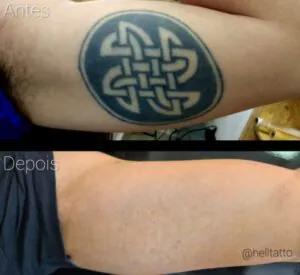 tem-regioes-do-corpo-que-e-mais-facil-remover-uma-tatuagem
