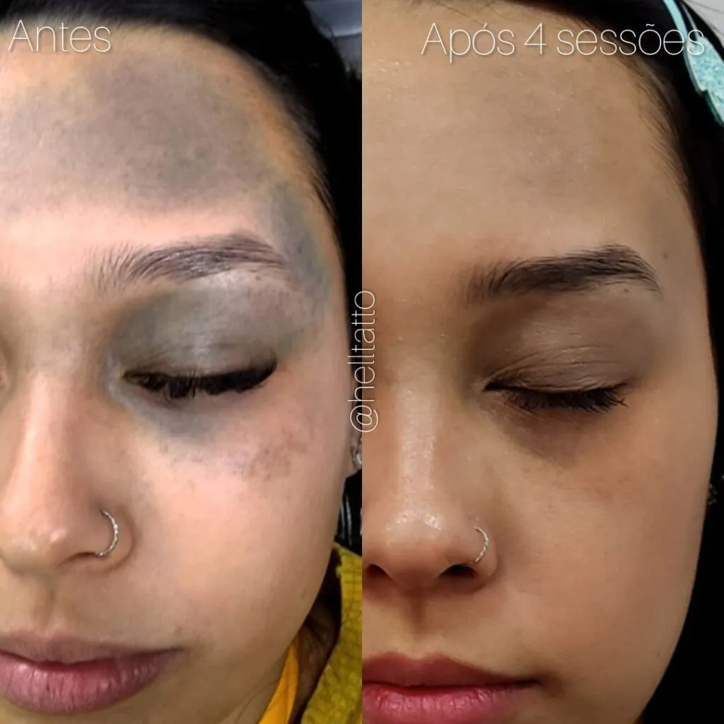 Nevo de Ota resultado hell tattoo