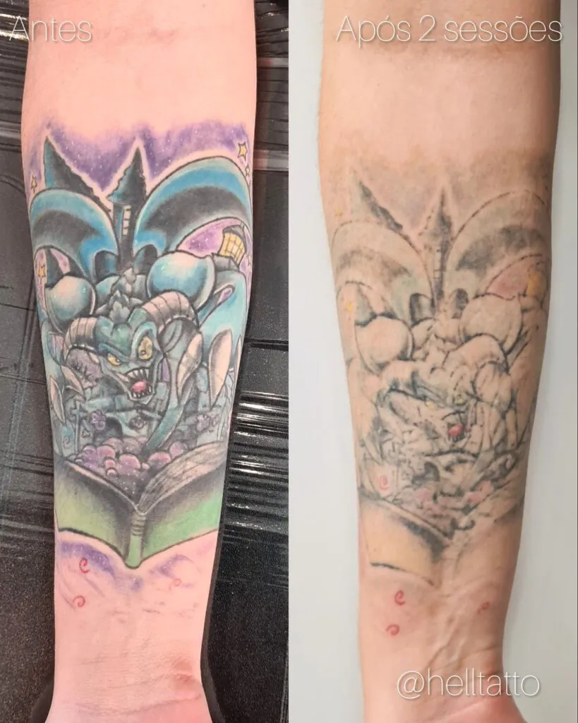Preço remoção de tatuagem colorida