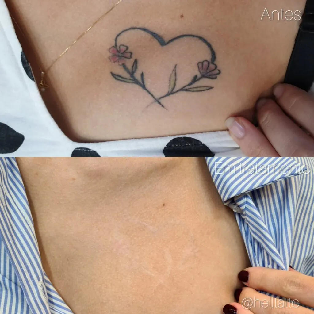 Preço-remoção-de-tatuagem