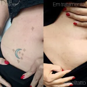 Remoção de tatuagem a laser resultado antes e depois