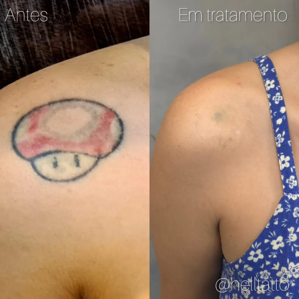 Tatuagem arrependem_tatuagem mário