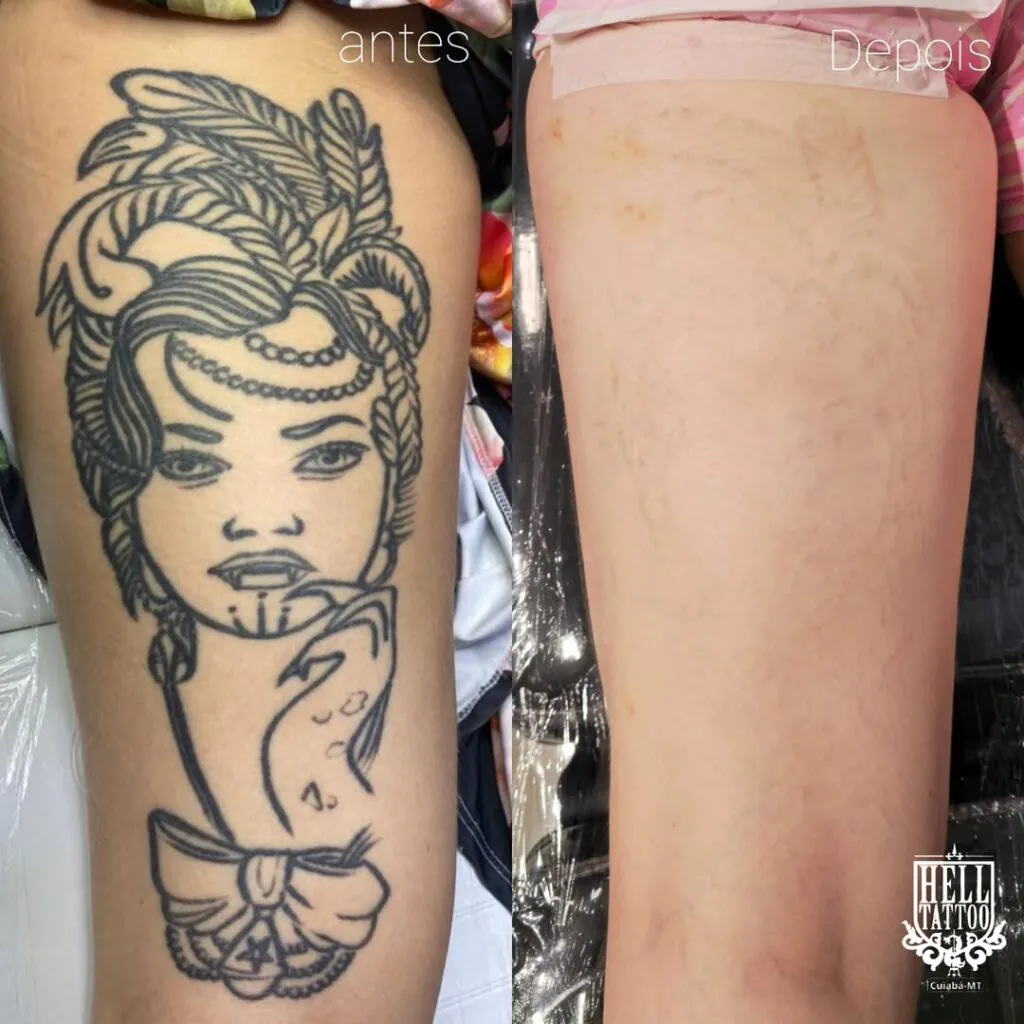 remoção de tatuagem hell tattoo