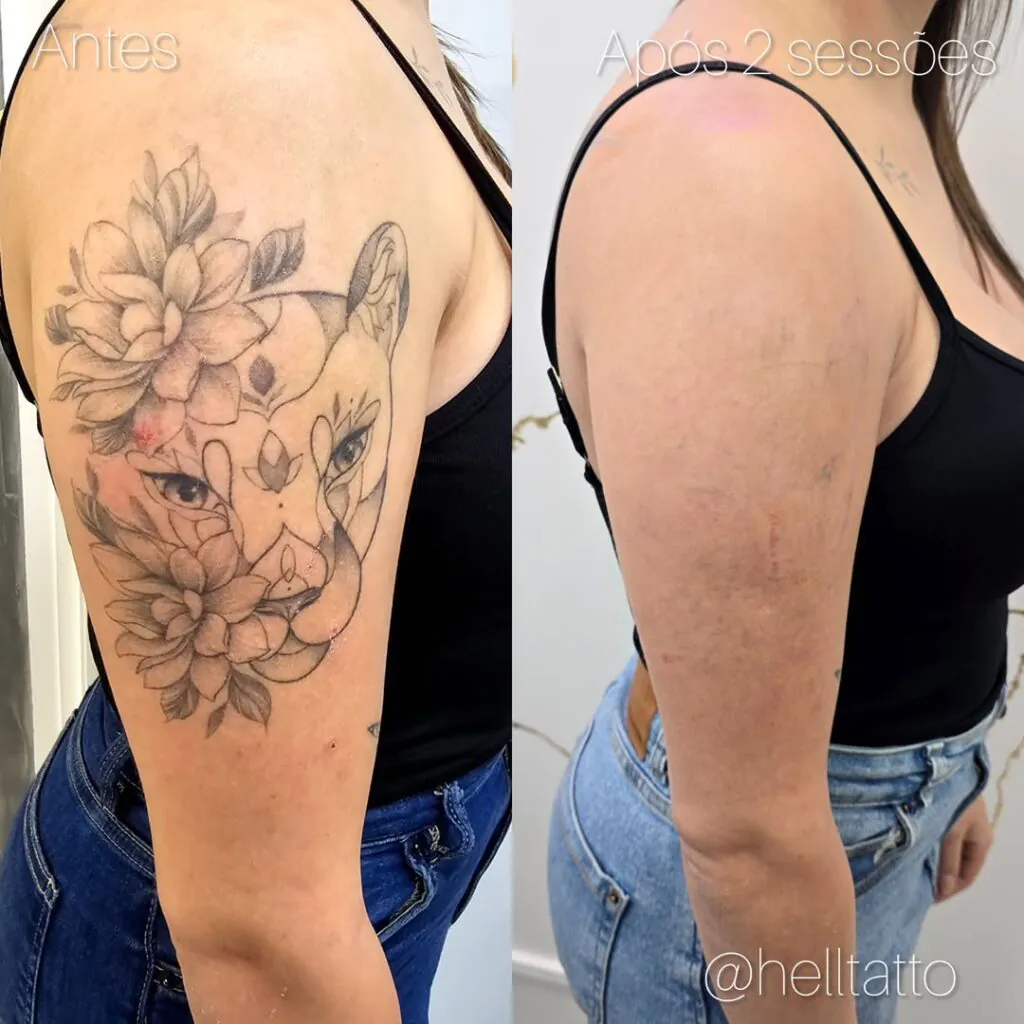 remoção-de-tatuagem-pessoa-arrependida-resultado