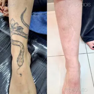 resultado-remoção-de-tatuagem-02