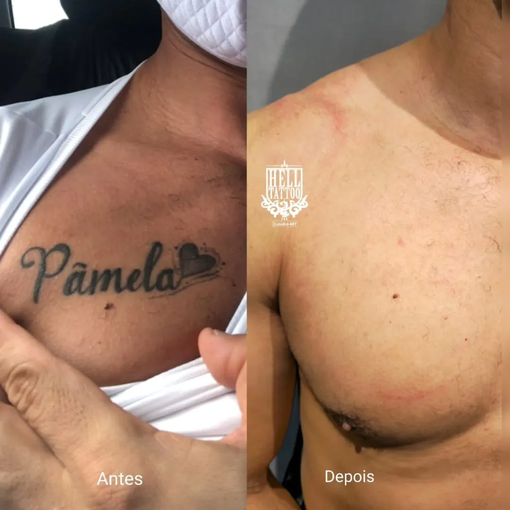 apagar tatuagem com nome ex 2