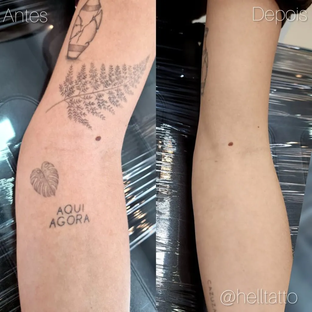 resultado remoção de tatuagem