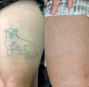 e-possivel-remover-tatuagem-com-tinta-xadrez