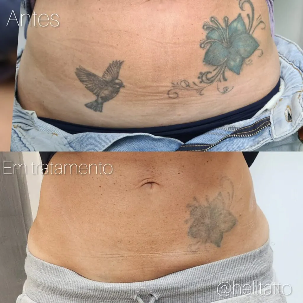 custo da remoção de tatuagem 1