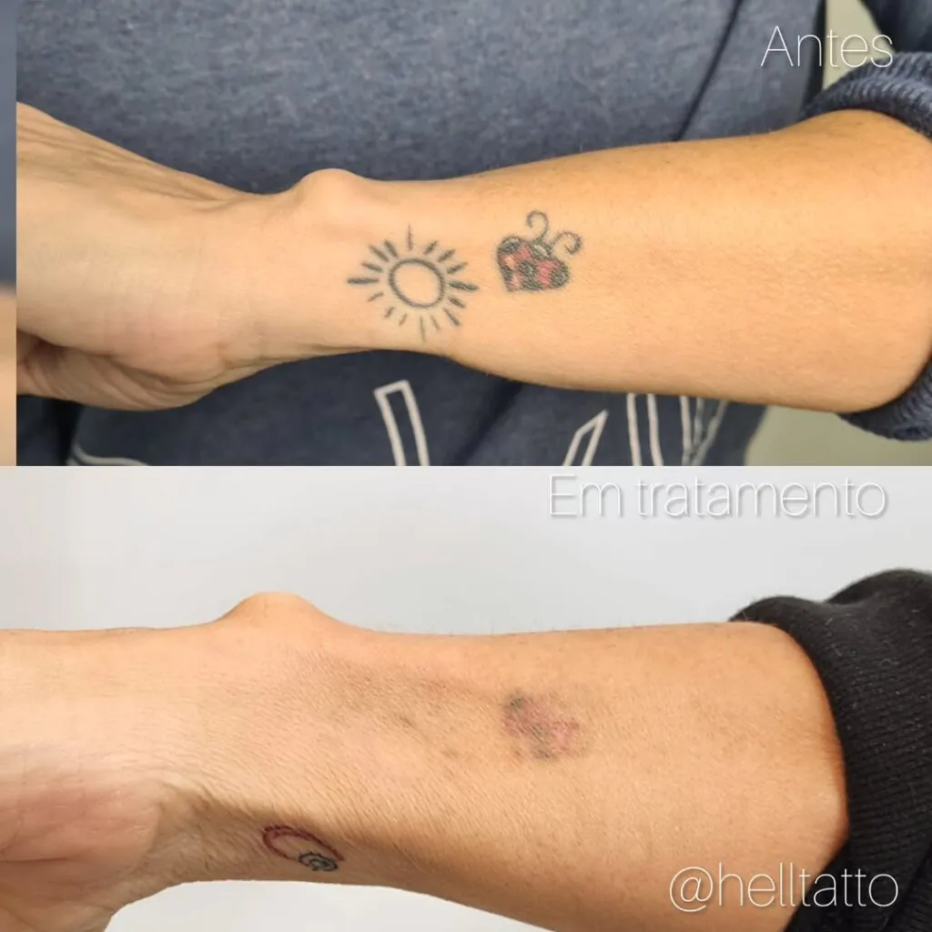 custo da remoção de tatuagem 2