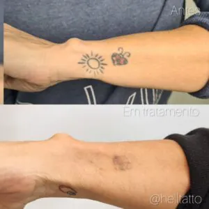 custo da remoção de tatuagem 2