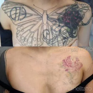 como-nao-sentir-dor-na-remocao-de-tatuagem-a-laser