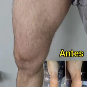 nevo-de-becker-conheca-um-tratamento-eficaz