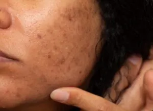 Melasma na gravidez - Foto: Freepik