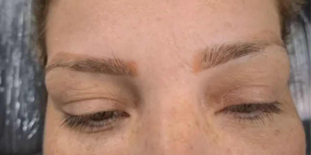 Remoção de Micropigmentação Laranja: É possível? Remoção de Micropigmentação Laranja