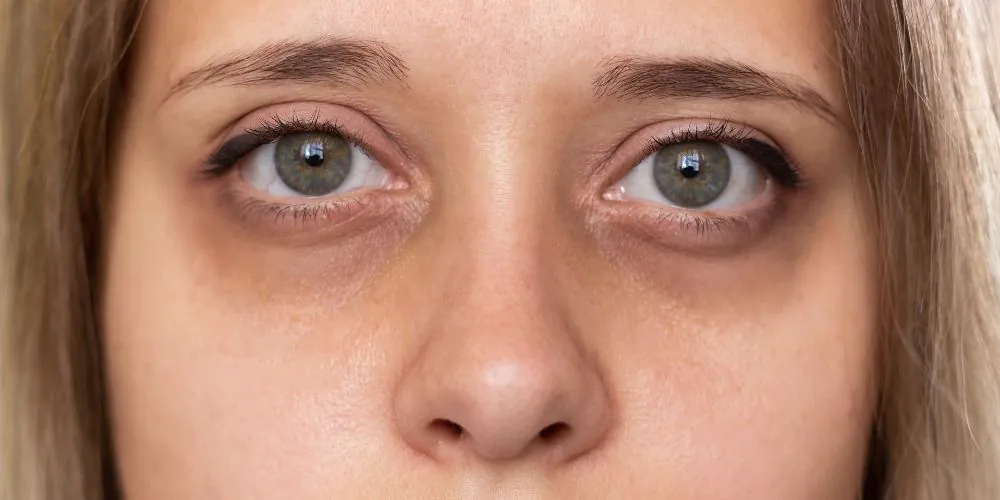 Remoção de Olheiras a Laser