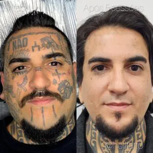 remoção de tatuagem tendência