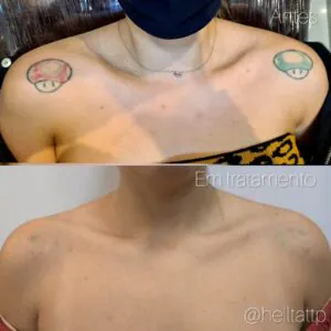 remocao-de-tatuagem-vermelha-e-possivel