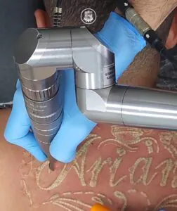 laser-bom-pode-remover-tatuagem
