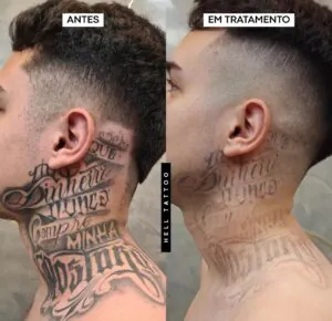 porque-tantas-pessoas-estao-removendo-suas-tatuagens