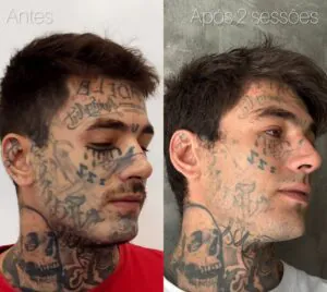 qual-e-o-resultado-de-duas-sessoes-de-remocao-de-tatuagem-02