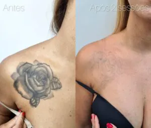 qual-e-o-resultado-de-duas-sessoes-de-remocao-de-tatuagem-03