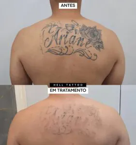 remover-uma-tatuagem-em-apenas-uma-sessao