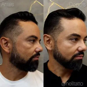 tratamento-de-melasma-em-homens