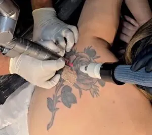 como-funciona-o-laser-de-picossegundos-na-remocao-de-tatuagens