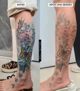 tempo-para-ver-os-resultados-da-remocao-de-tatuagem-02