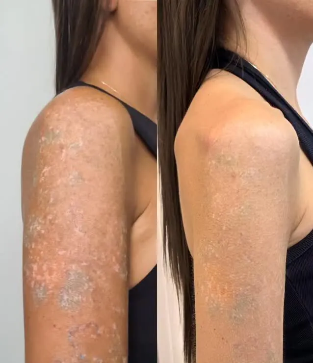 remoção de tatuagem com cicatrizes