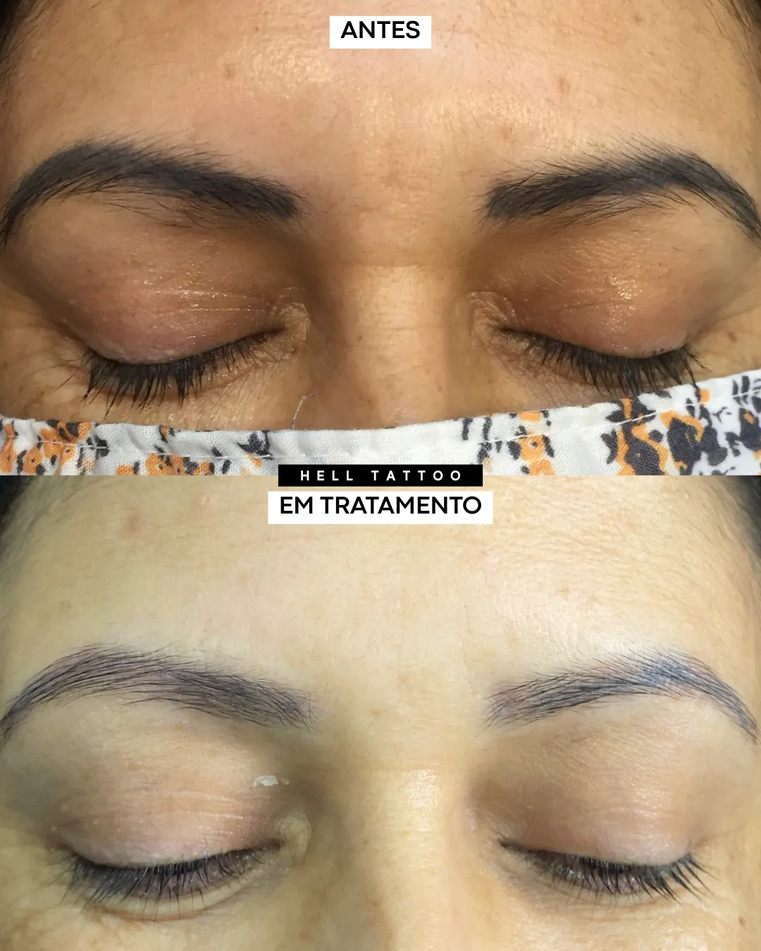 remover micropigmentação