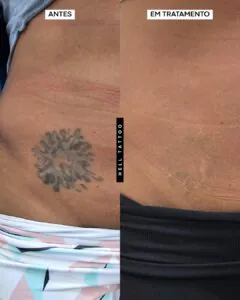 remover tatuagem em regiões íntimas