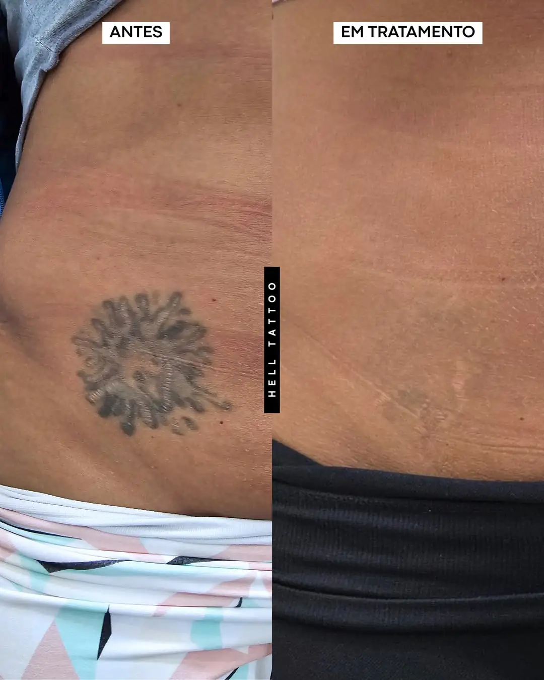 remover tatuagem em regiões íntimas