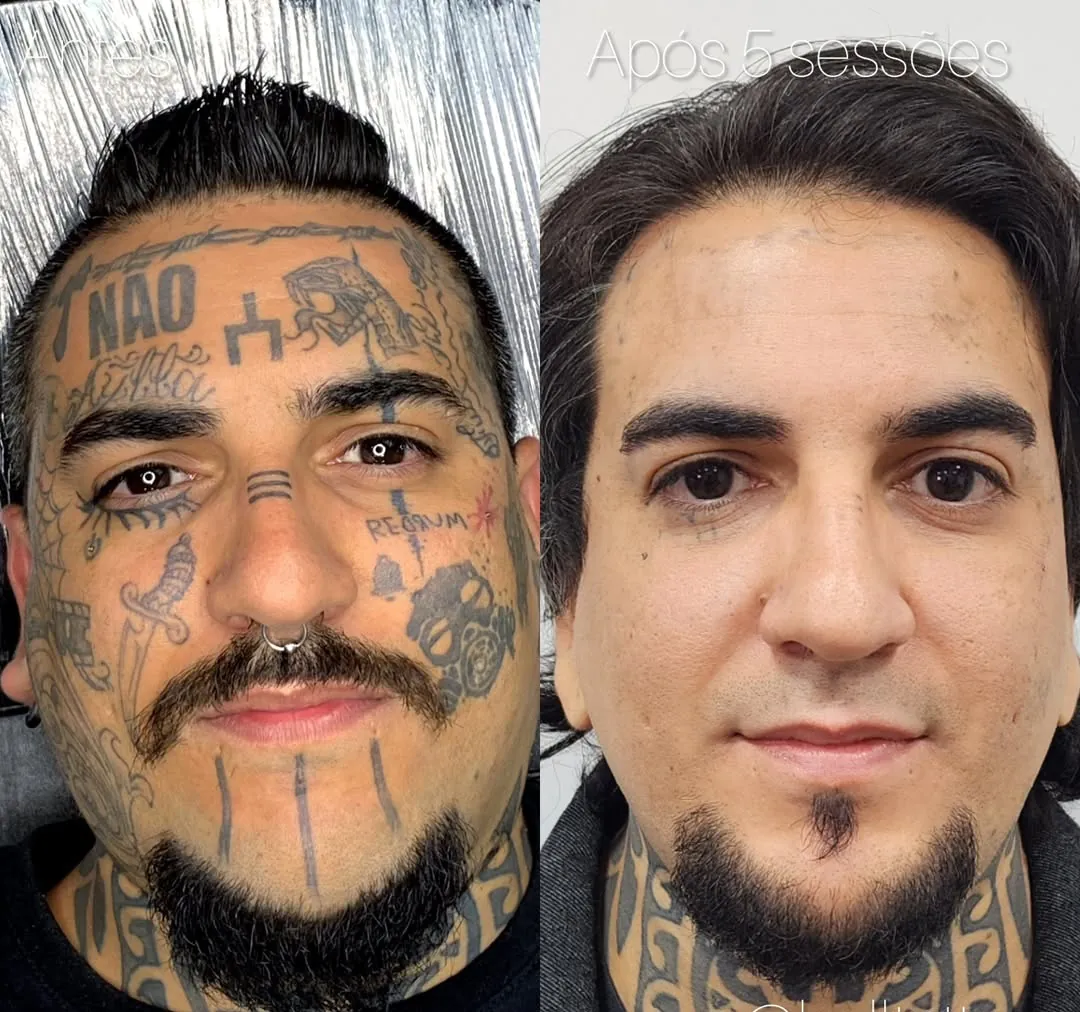 tem-como-remover-tatuagem