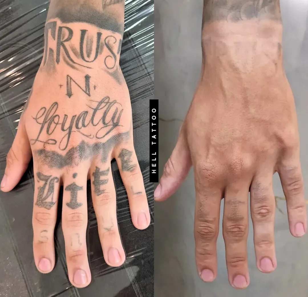 aumento-por-remocao-de-tatuagem-impulsiona-mercado