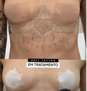 cicatriz-pos-sessao-de-laser-o-erro-que-pode-custar-caro