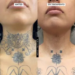 remoção de tataugem no pescoço