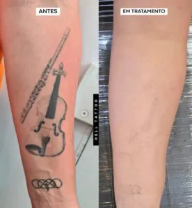 valor-da-remocao-de-tatuagem-na-hell-tattoo-01