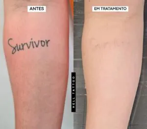 valor-da-remocao-de-tatuagem-na-hell-tattoo-02