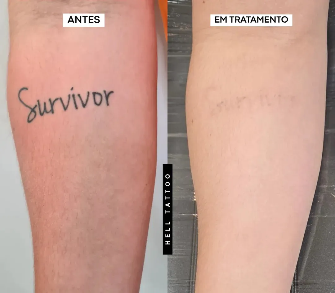 valor-da-remocao-de-tatuagem-na-hell-tattoo-02