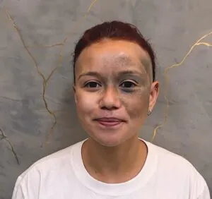 nevo-de-ota-mancha-no-rosto-tem-solucao-02