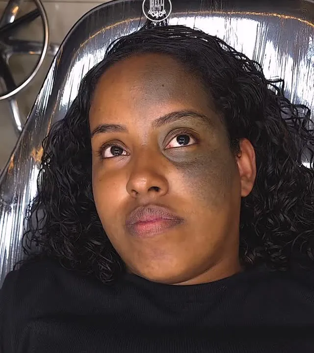 nevo-de-ota-mancha-no-rosto-tem-solucao