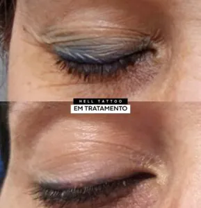 remocao-de-delineado-dos-olhos-e-segura-entenda-o-procedimento