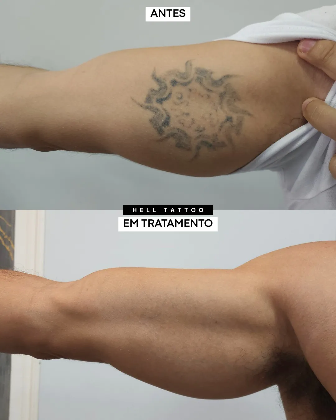 da-para-remover-tatuagem-com-poucas-sessoes