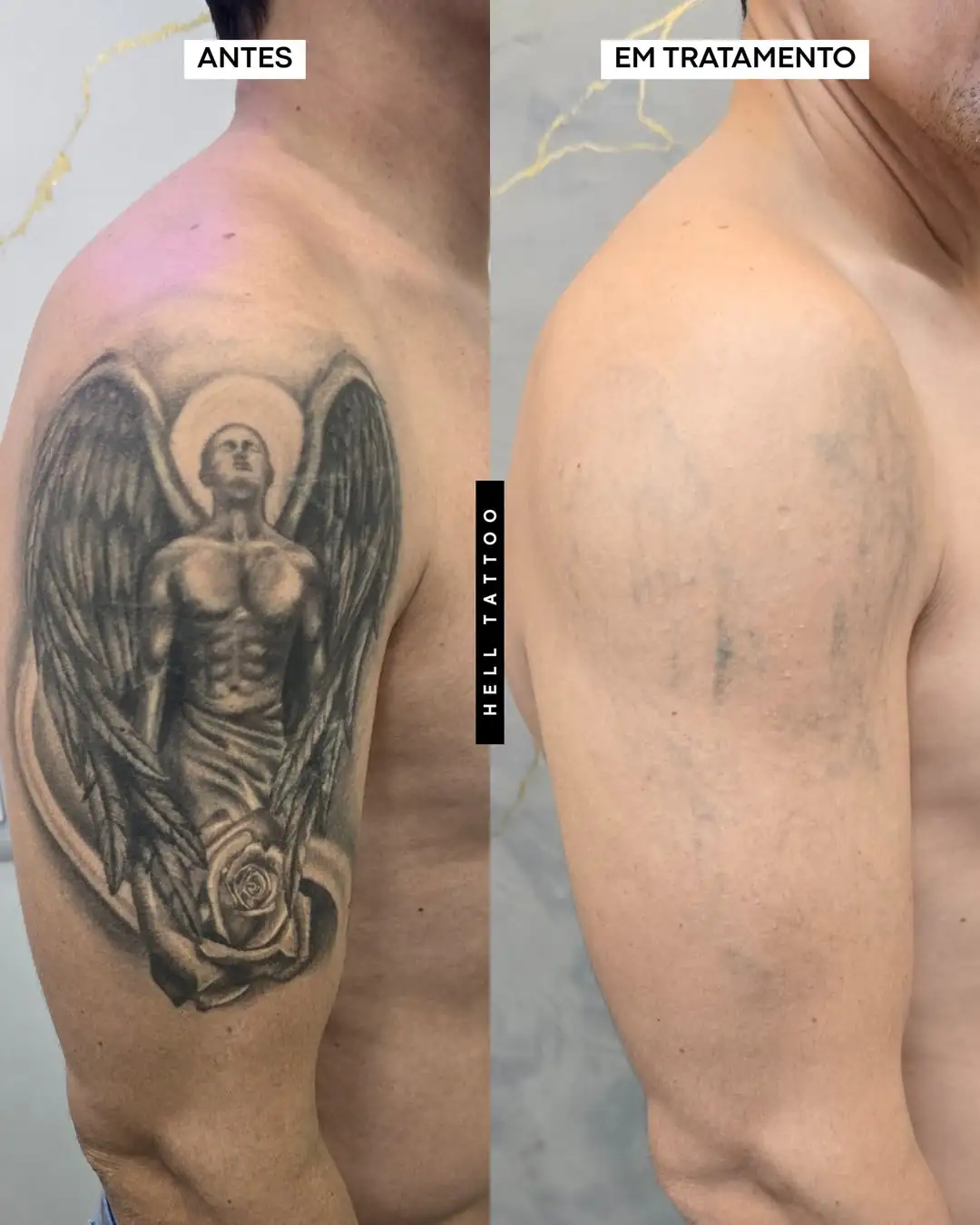 clareamento de tatuagem