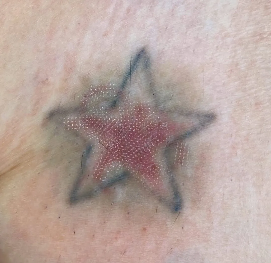 laser-fracionado-pos-remocao-e-bom-entenda
