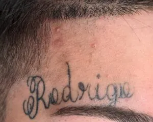 remoção tatuagem de nomes