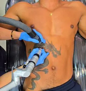 da-para-remover-tatuagem-com-laser-02